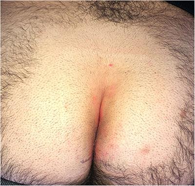 Pediatric Endoscopic <mark class="highlighted">Pilonidal Sinus</mark> Treatment (PEPSiT) in Children With <mark class="highlighted">Pilonidal Sinus</mark> Disease: Tips and Tricks and New Structurated Protocol